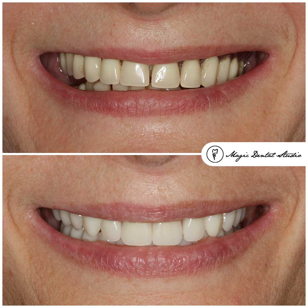proteza, denture, uśmiech przed i po