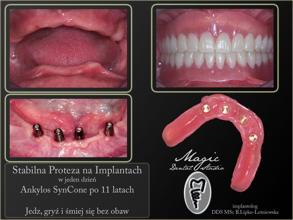 syncone, proteza, implanty, Poznań